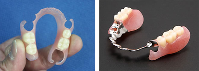 金属を使用しないノンクラスプデンチャーの写真