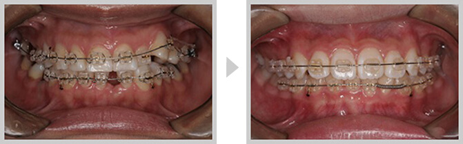 矯正治療の画像