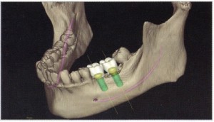 診断および３Dインプラントプランニング