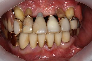 歯周病の症状①
