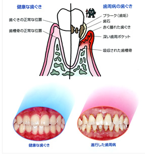 歯周病の特徴