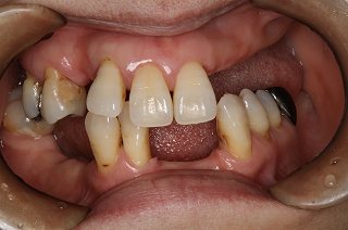 歯周病を放置したらどうなりますか？